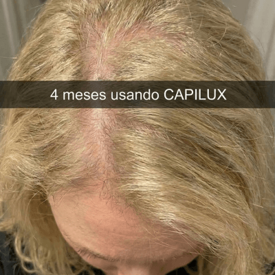 4 meses usando Capilux — novos fios visíveis
